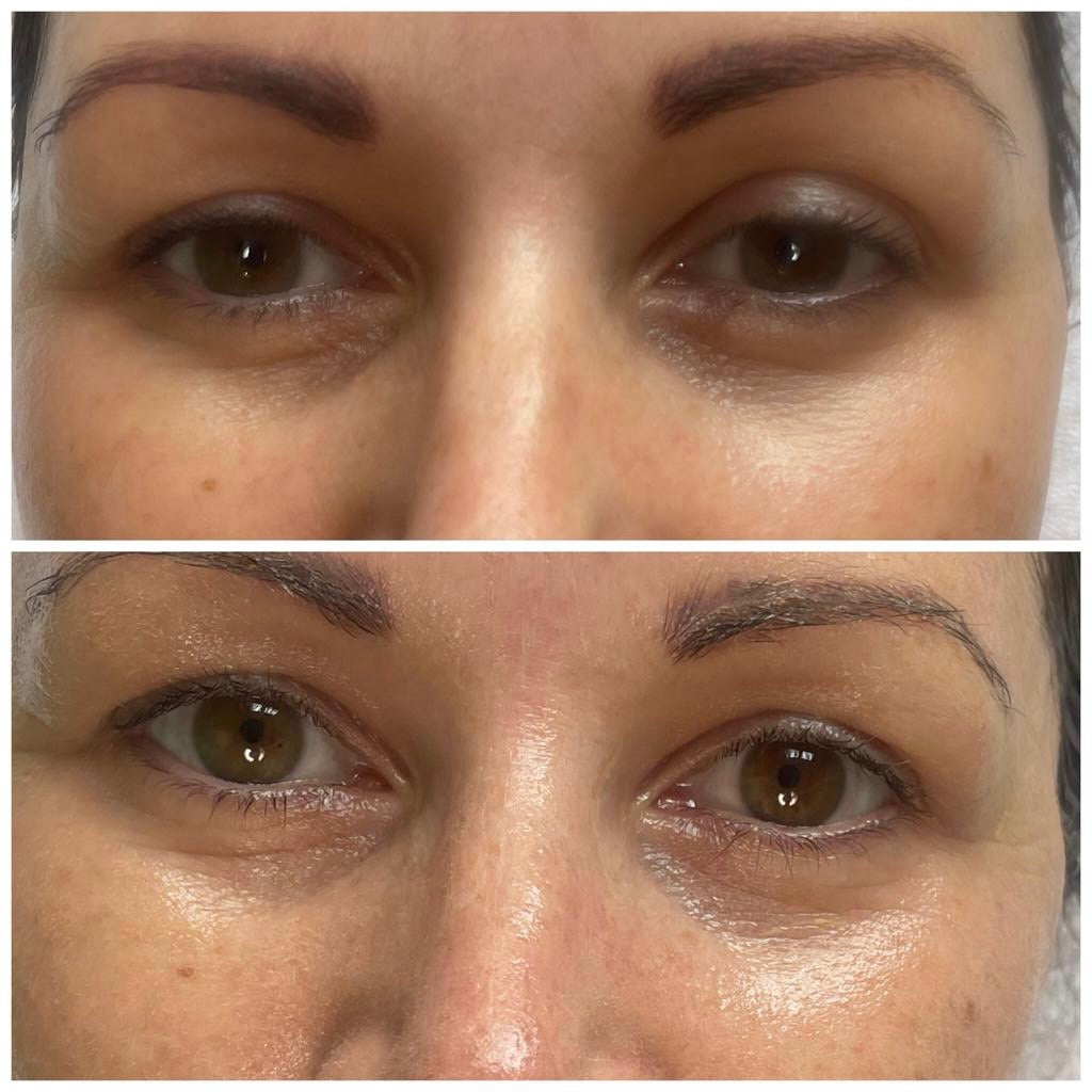Microneedling Facial