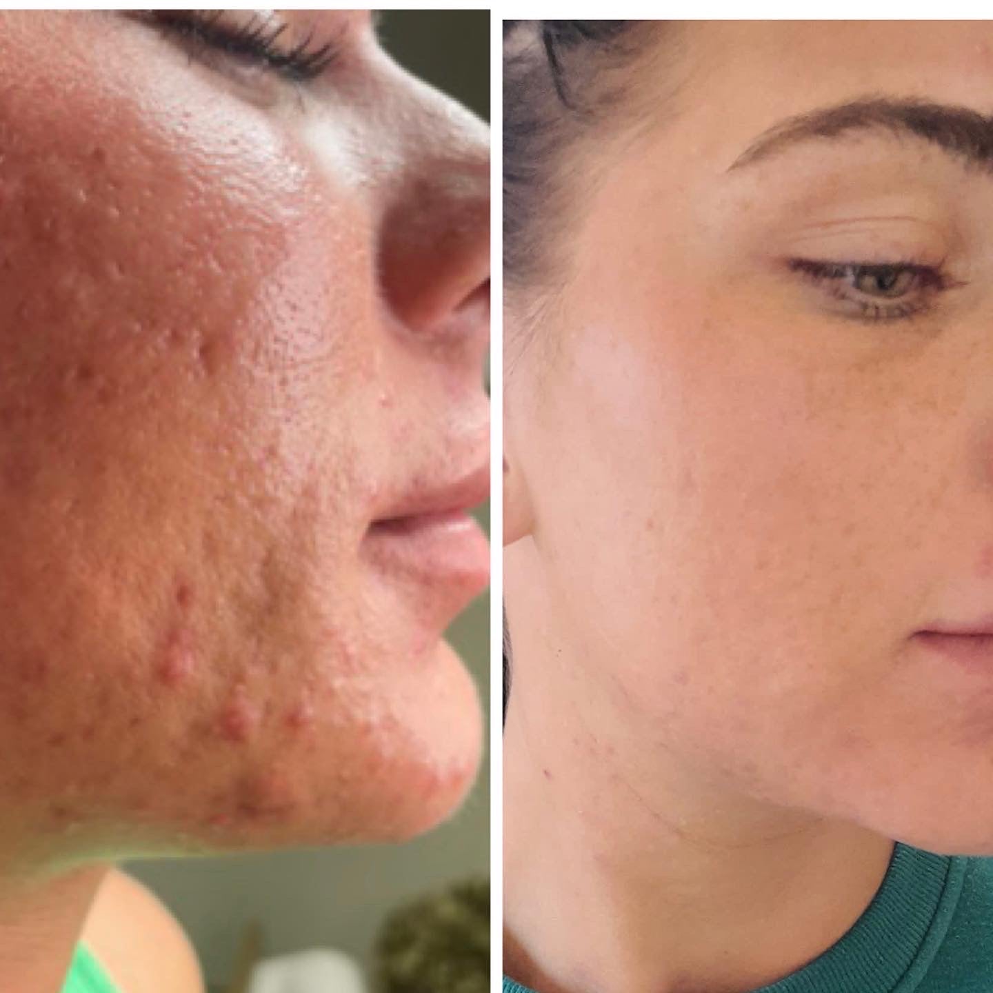 Microneedling 18 week Correction Programme