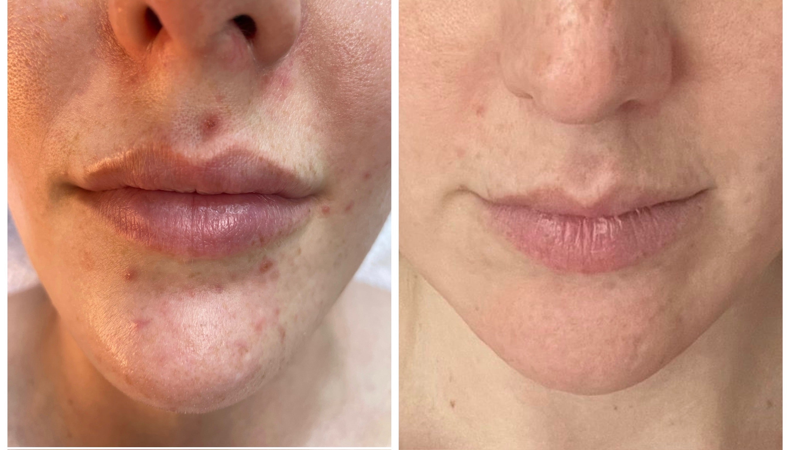 Microneedling 18 week Correction Programme
