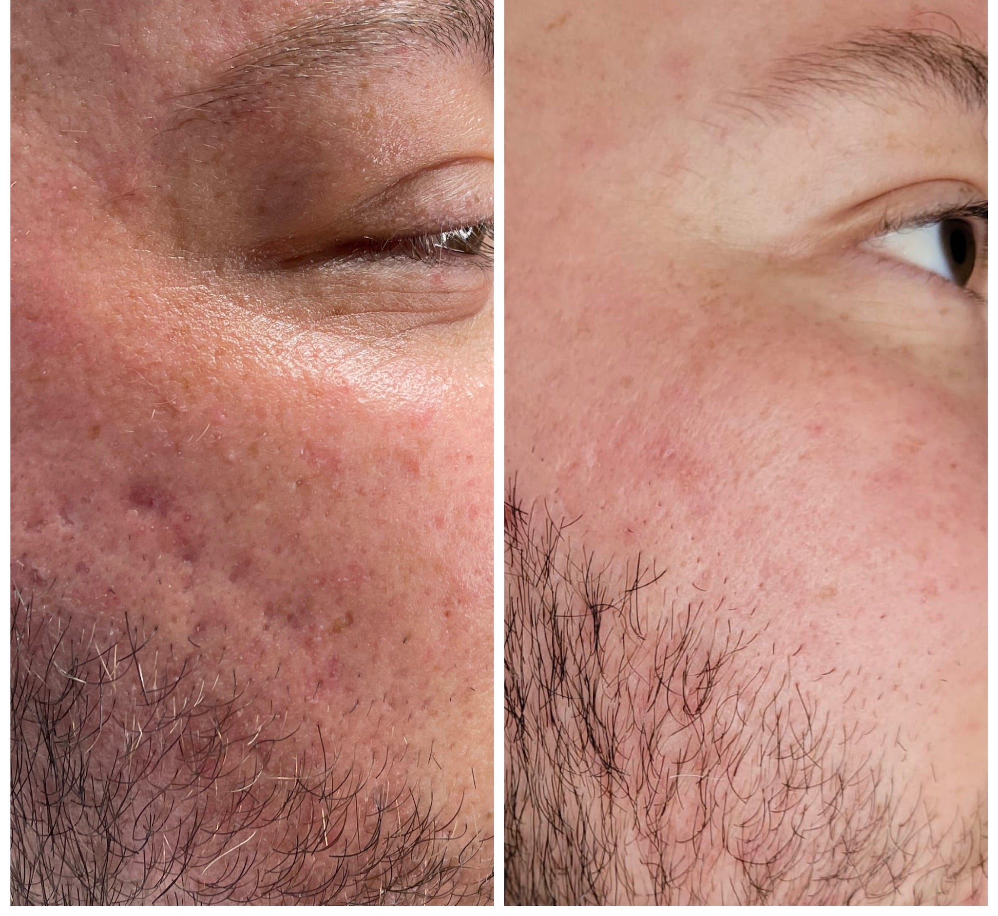 Microneedling 18 week Correction Programme