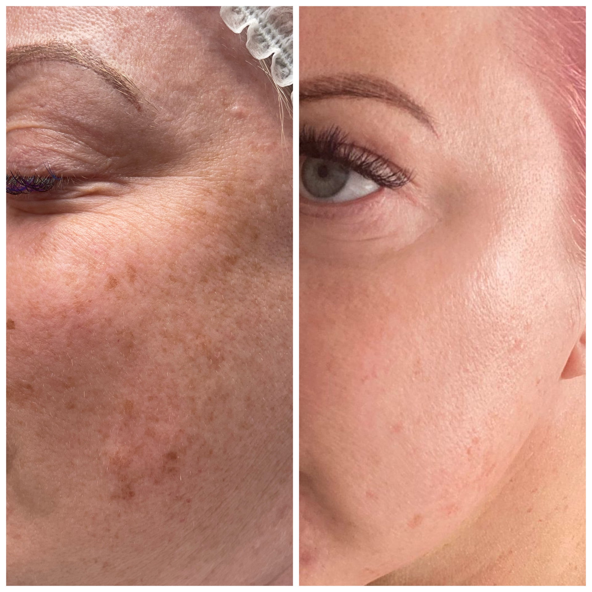 Microneedling 18 week Correction Programme