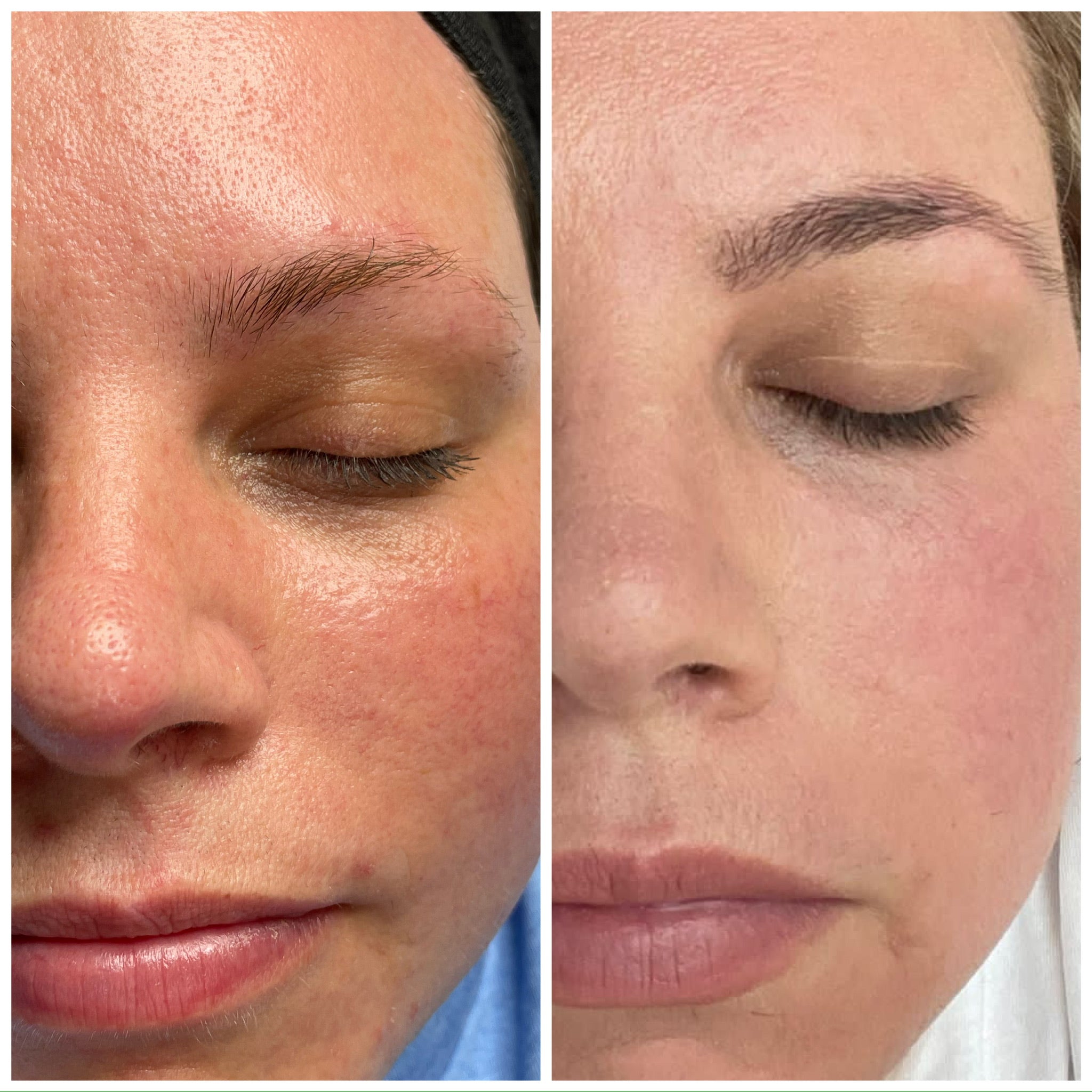 Microneedling 18 week Correction Programme