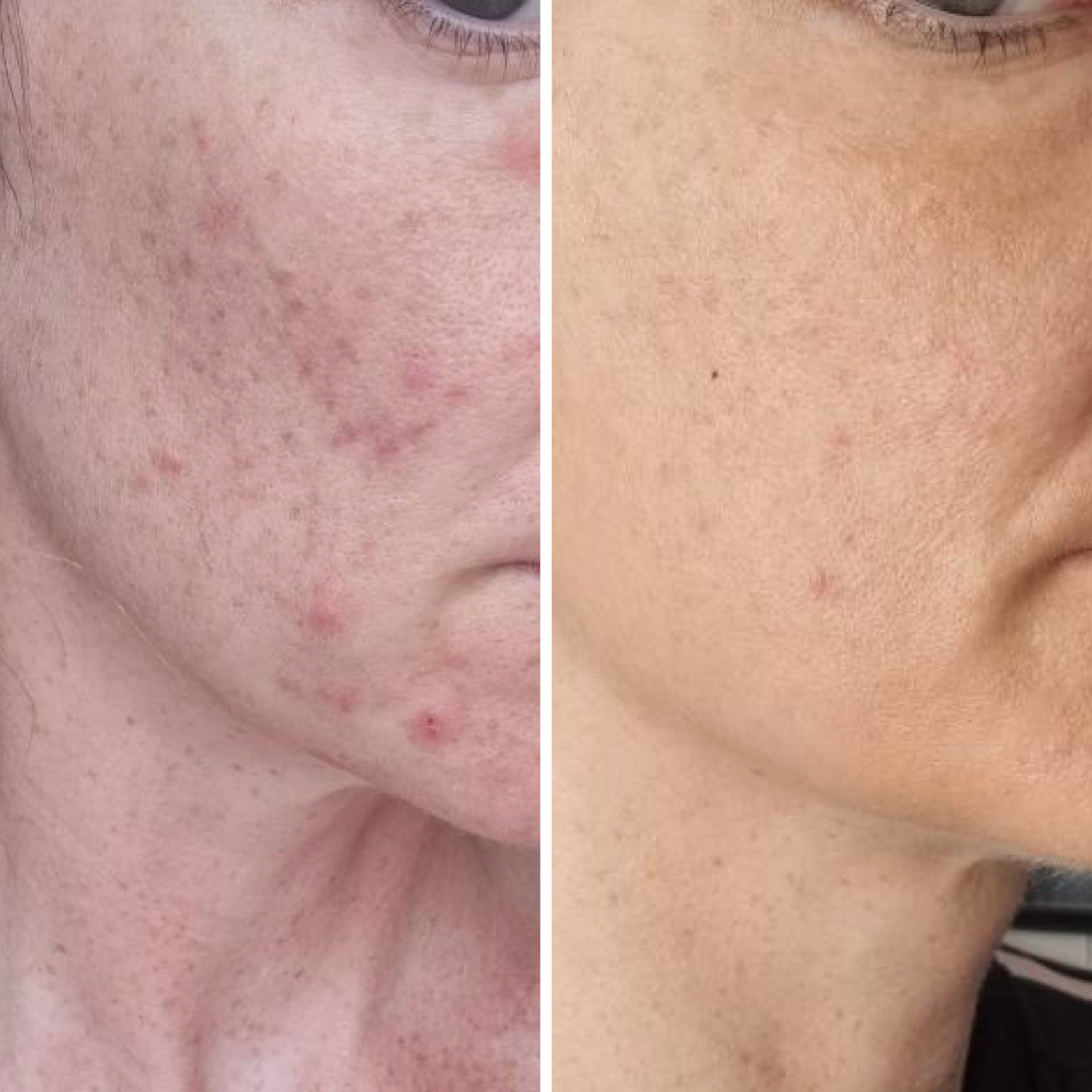 Microneedling 18 week Correction Programme