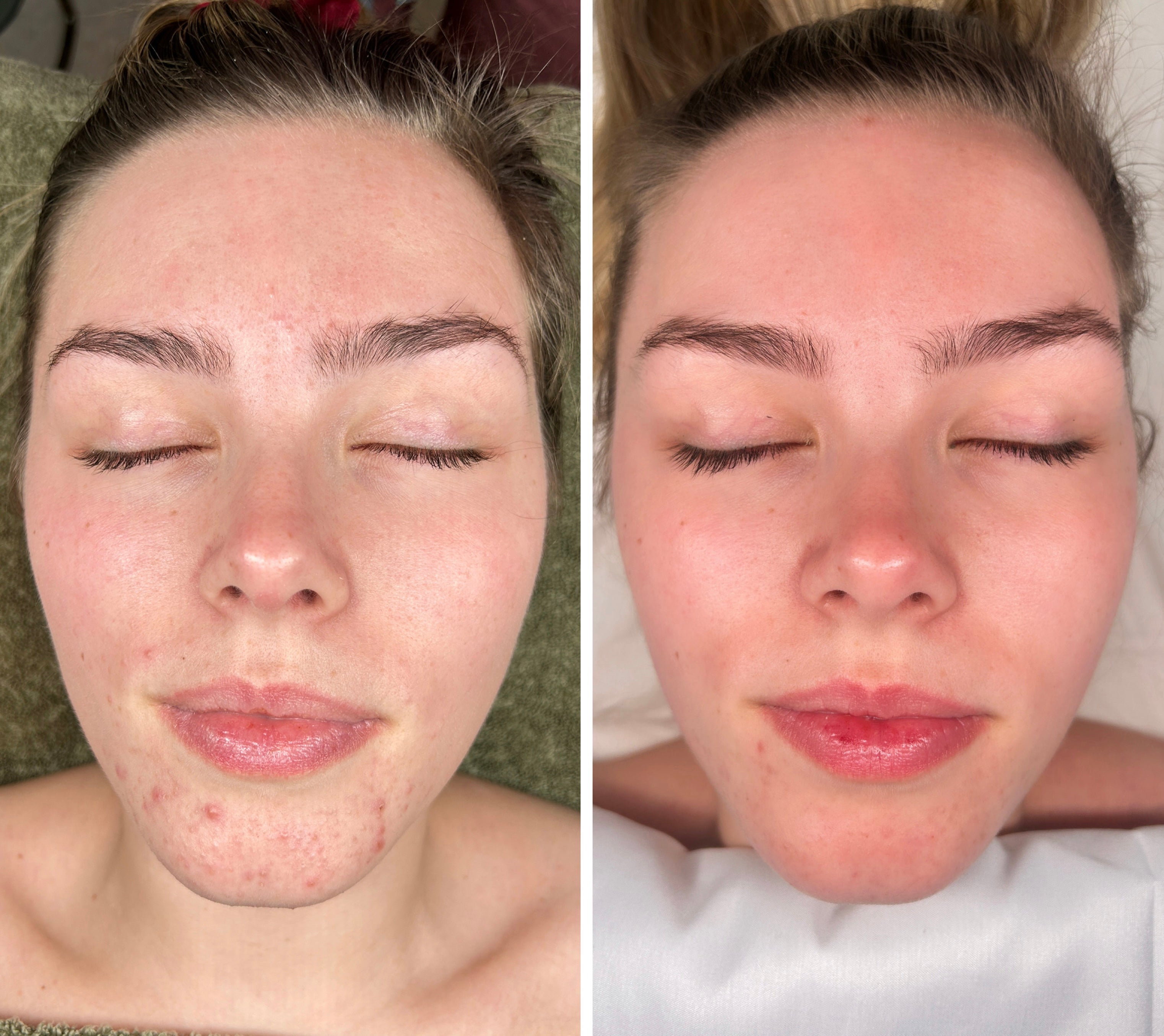 Microneedling 18 week Correction Programme