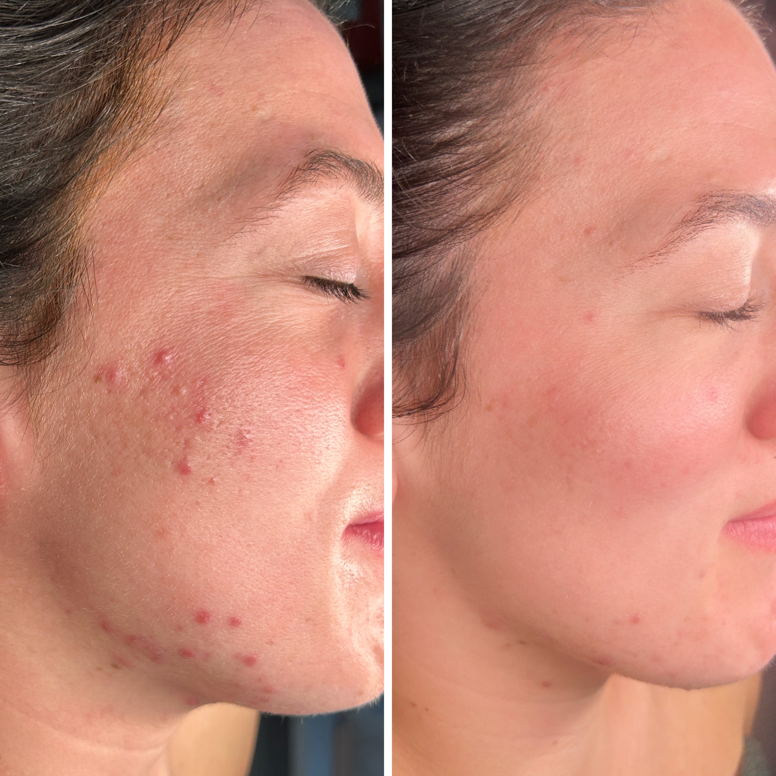 Microneedling 18 week Correction Programme