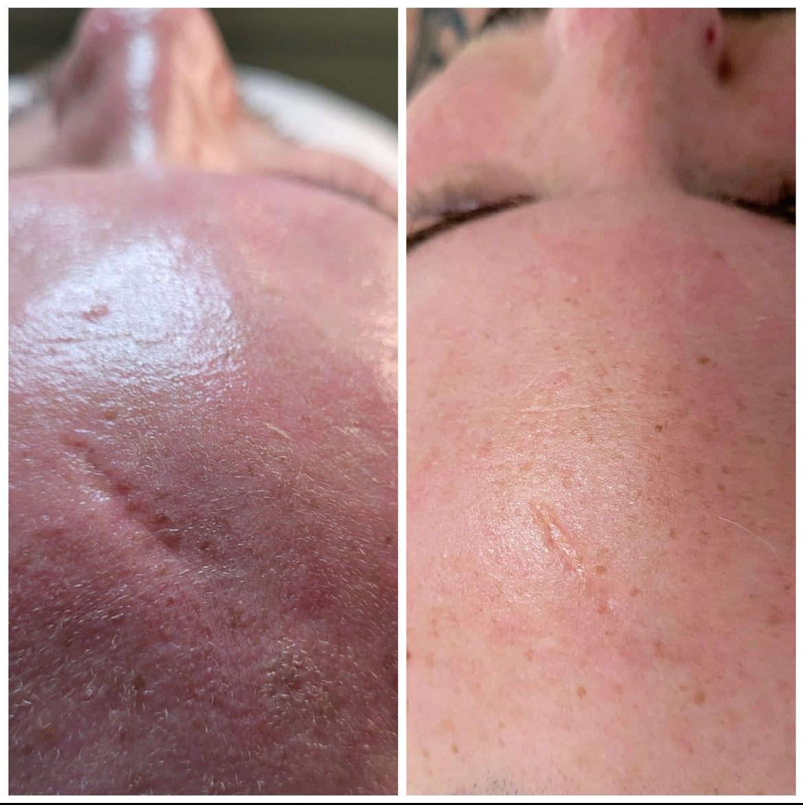Microneedling 18 week Correction Programme