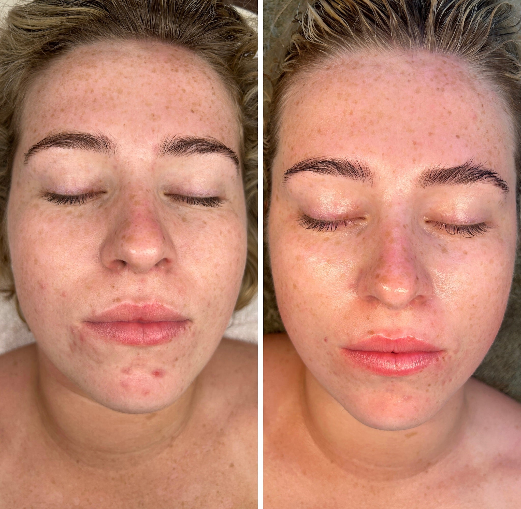 Microneedling 18 week Correction Programme