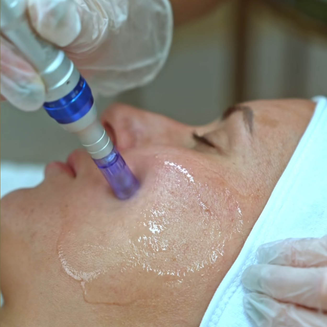 Microneedling 18 week Correction Programme
